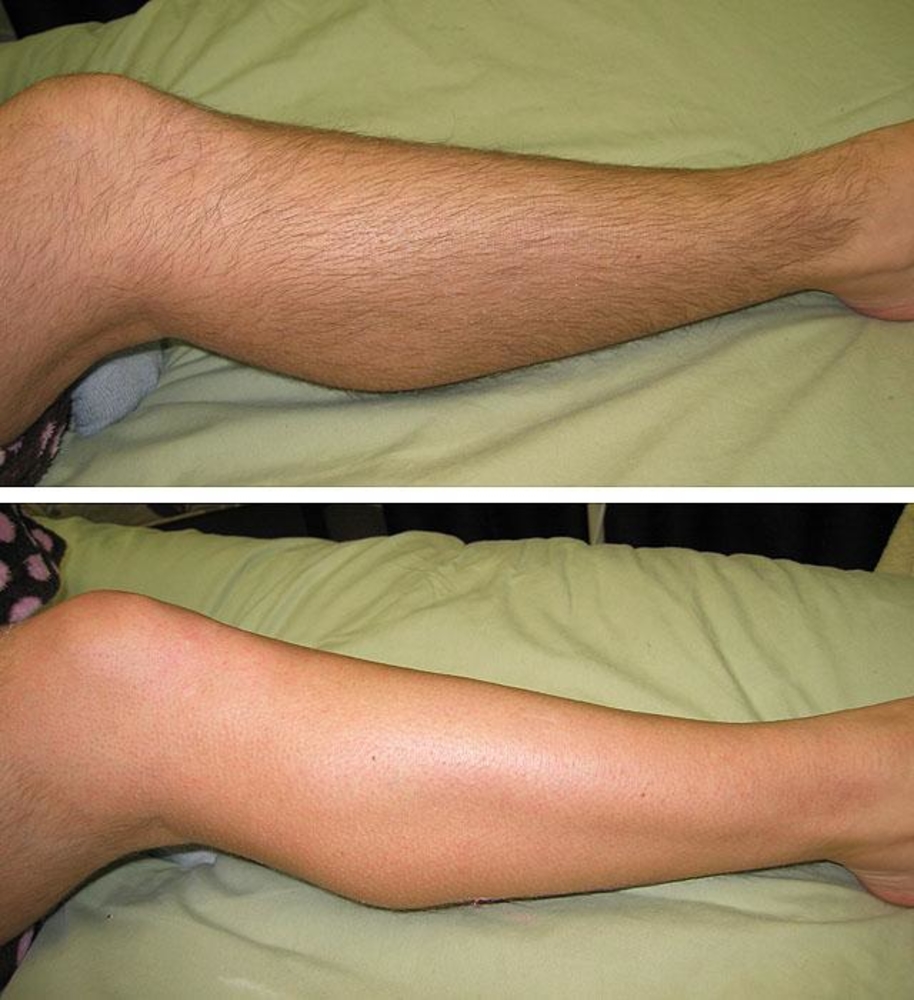 Депиляция ног фото до и после